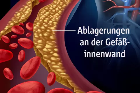 Illustration des Inneren eines menschlichen Blutgefäßes mit roten Blutkörperchen und Plaque, die als gelbliche Ablagerungen entlang der Innenwand der Arterie dargestellt sind.